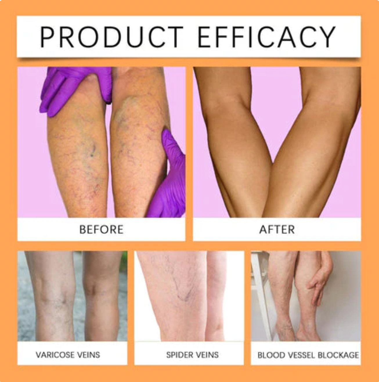 Richavita™ Varicose Veins  Spray